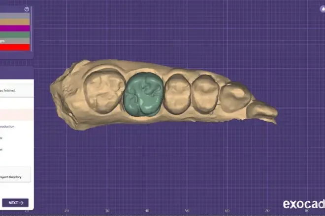 Zirconia crown and bridge made at Yes Dental lab, Faridabad