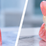 Crown vs Denture: How Dentists Decide and What a Dental Lab Can Make for Each