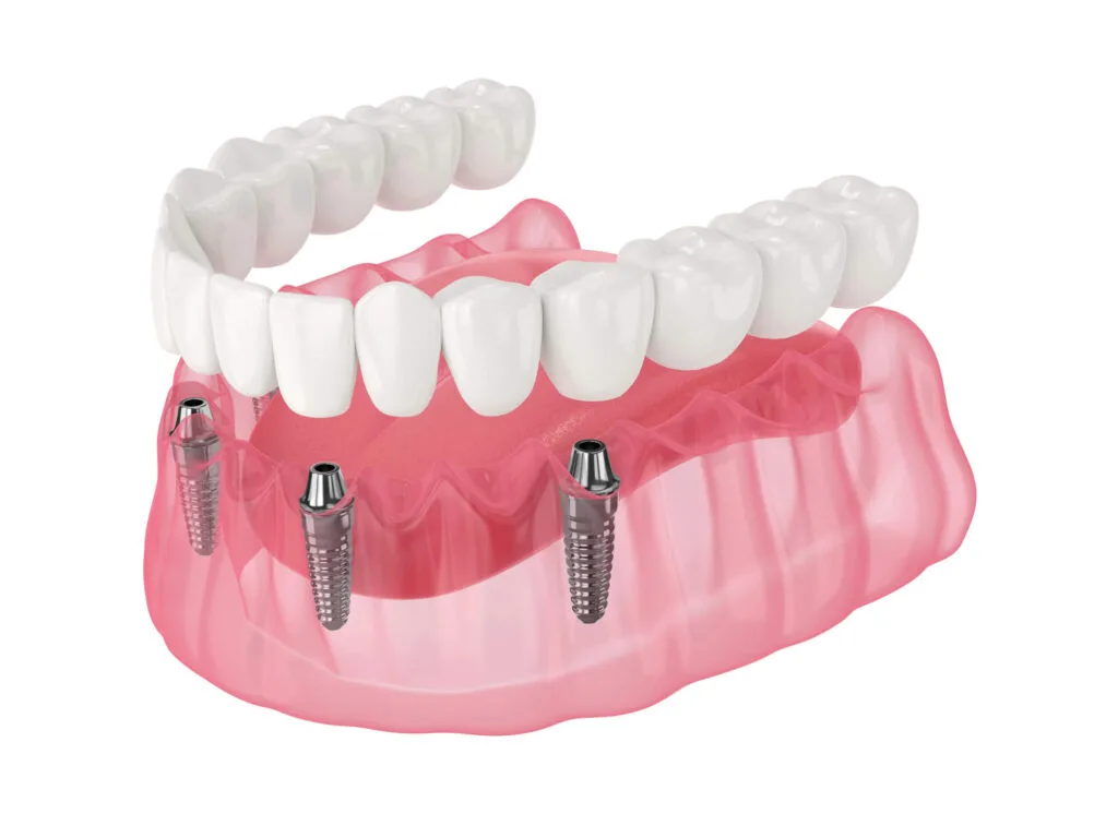 All-on-X full-arch prosthesis made at Yes Dental