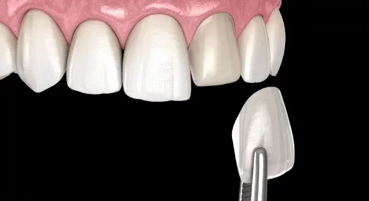 e.max crown and veneer restorations