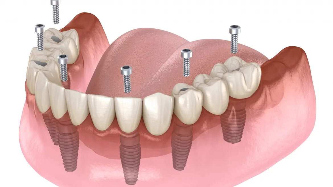 Implant bridge restoration made at Yes Dental