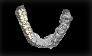 Lower arch crown and bridge made at Yes Dental