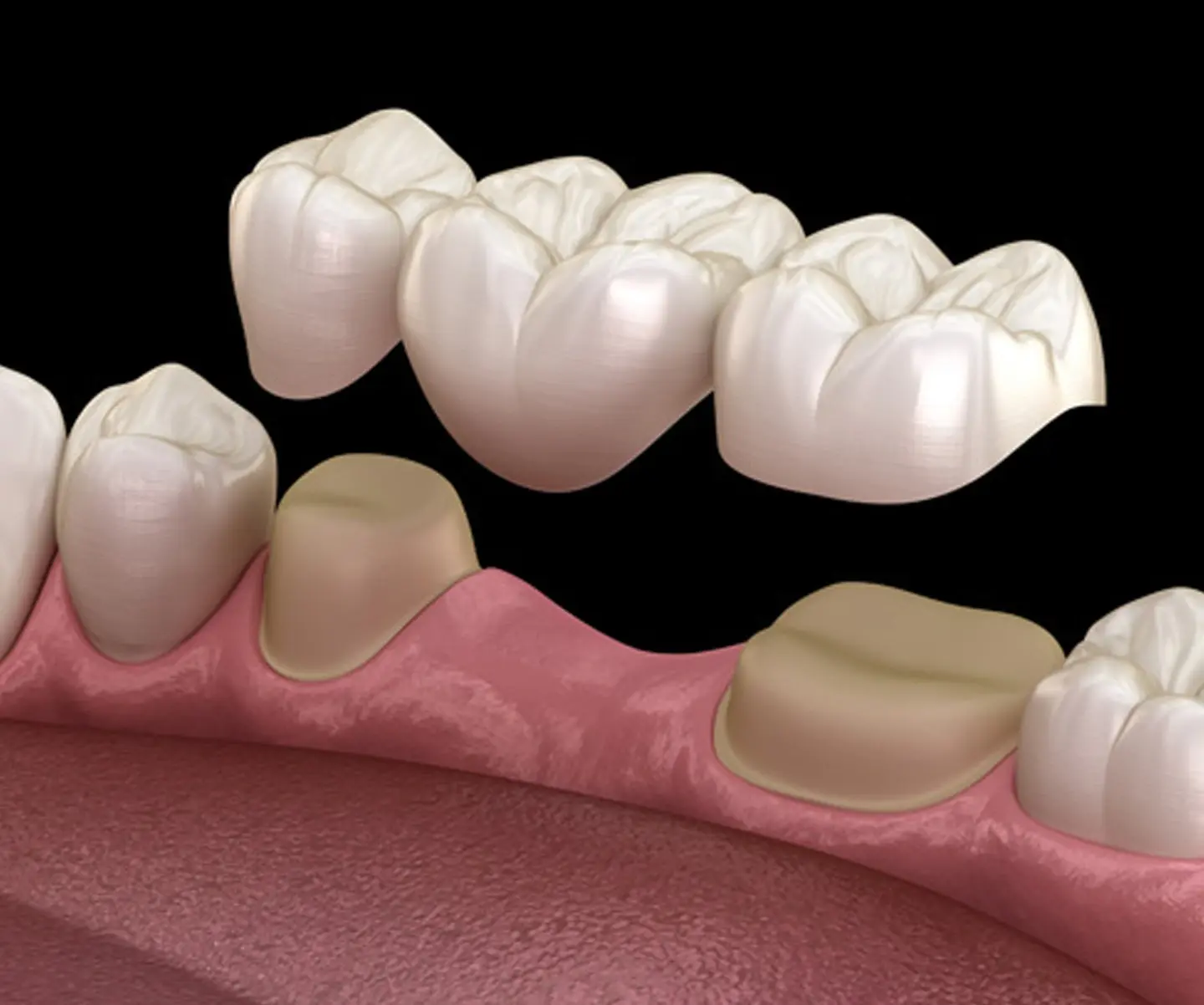 Dental crown and bridge products