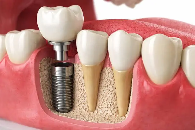 Implant crown and bridge made at Yes Dental