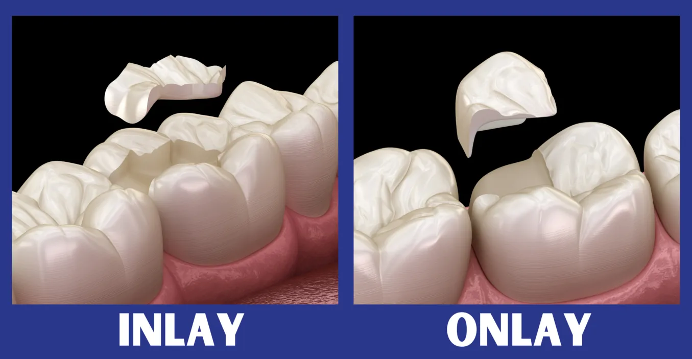 Dental inlay and onlay restorations