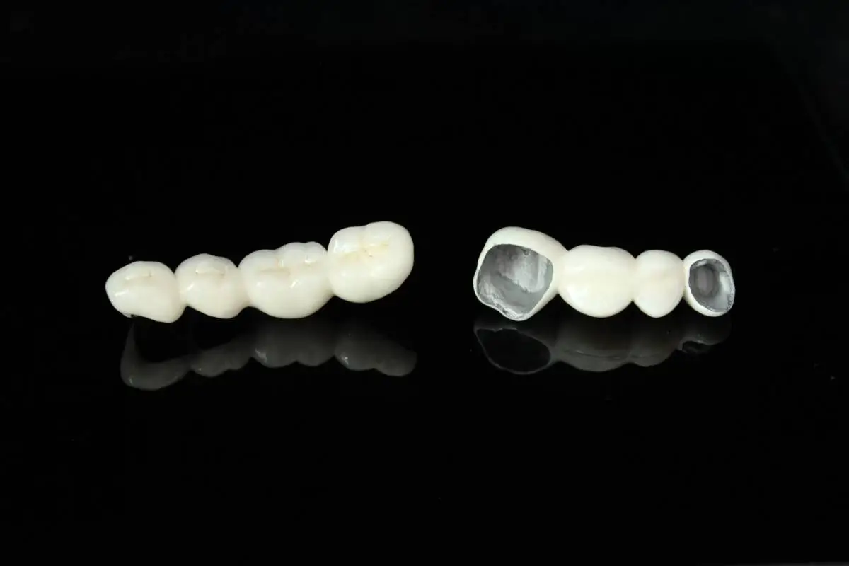 Metal and porcelain-fused-to-metal dental restorations